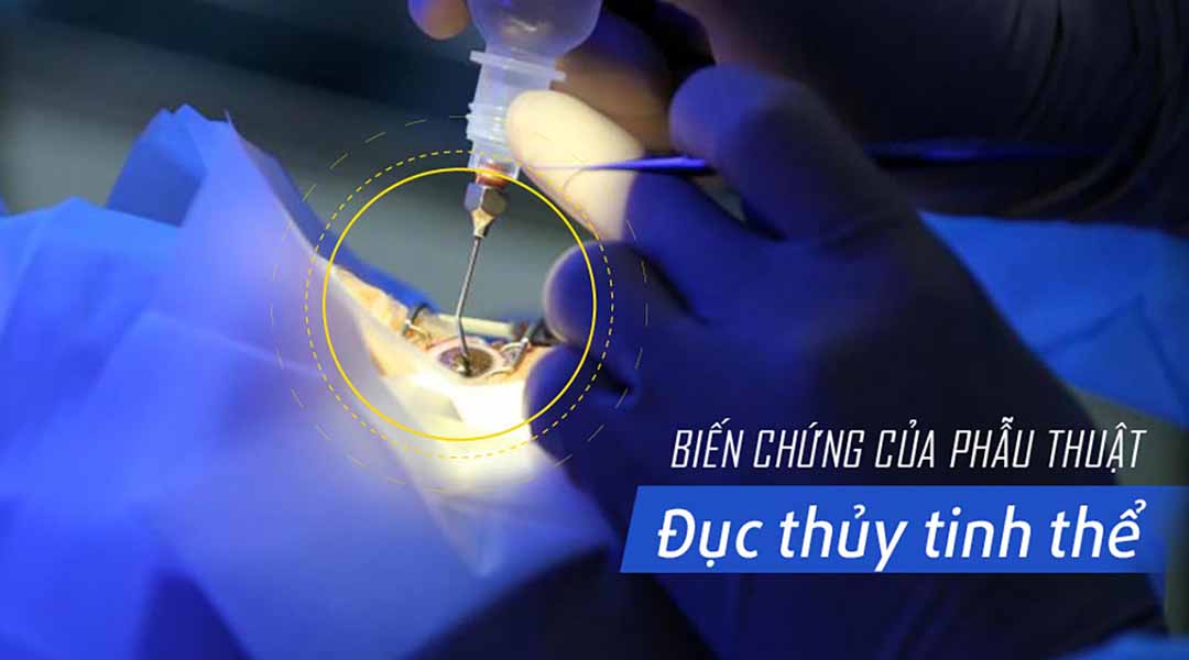 Biến chứng của phẫu thuật đục thủy tinh thể