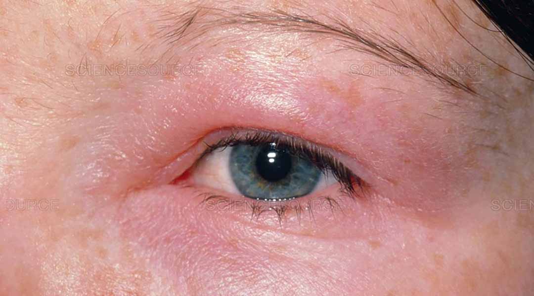 Phù hoàng điểm mắt là một trong những bệnh có thể xảy ra khi VMA không được điều trị.