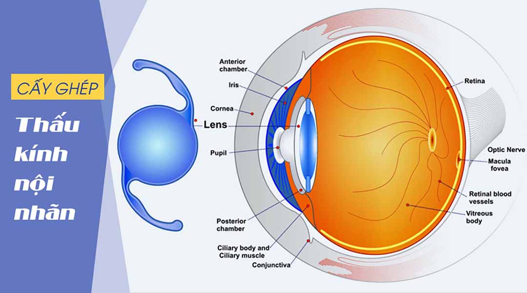 Cấy ghép thấu kính nội nhãn (thủy tinh thể nhân tạo) là gì?