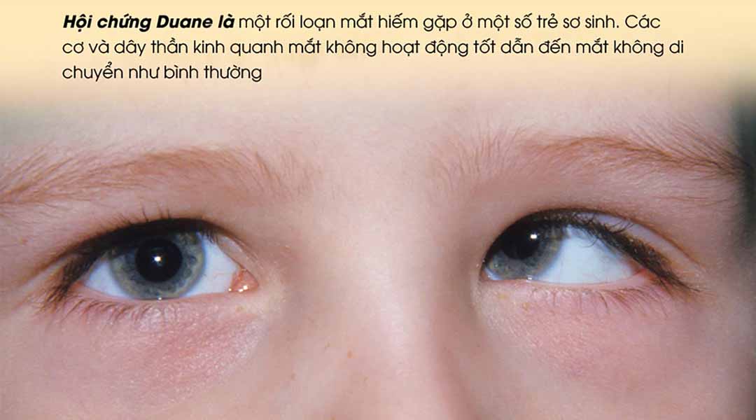 Hội chứng Duane là gì?