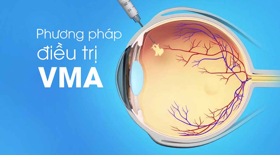 Phương pháp điều trị triệu chứng của độ kết dính thủy tinh thể (VMA)