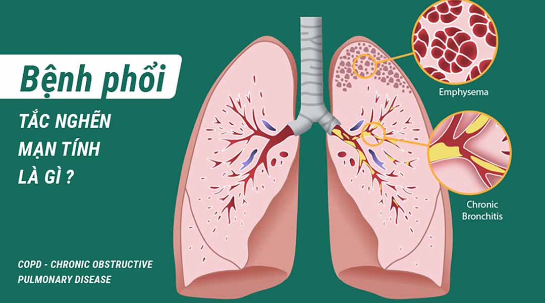 Bệnh phổi tắc nghẽn mạn tính (COPD - Chronic Obstructive Pulmonary Disease) là gì?