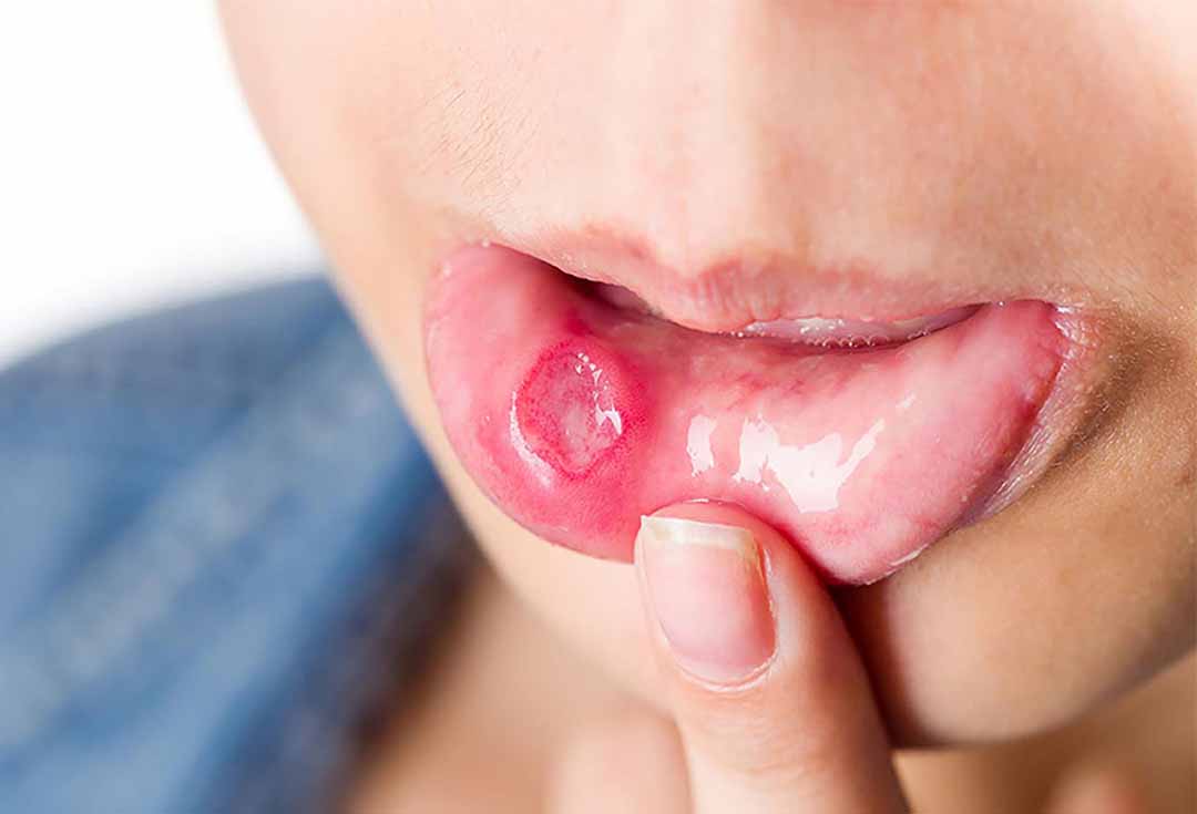Một trong các tác dụng phụ khi hóa trị là loét miệng (lở miệng).