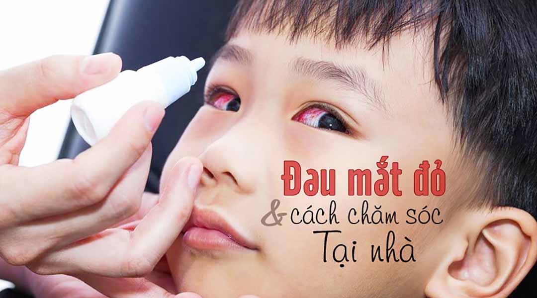 Cách chăm sóc bệnh đau mắt đỏ tại nhà