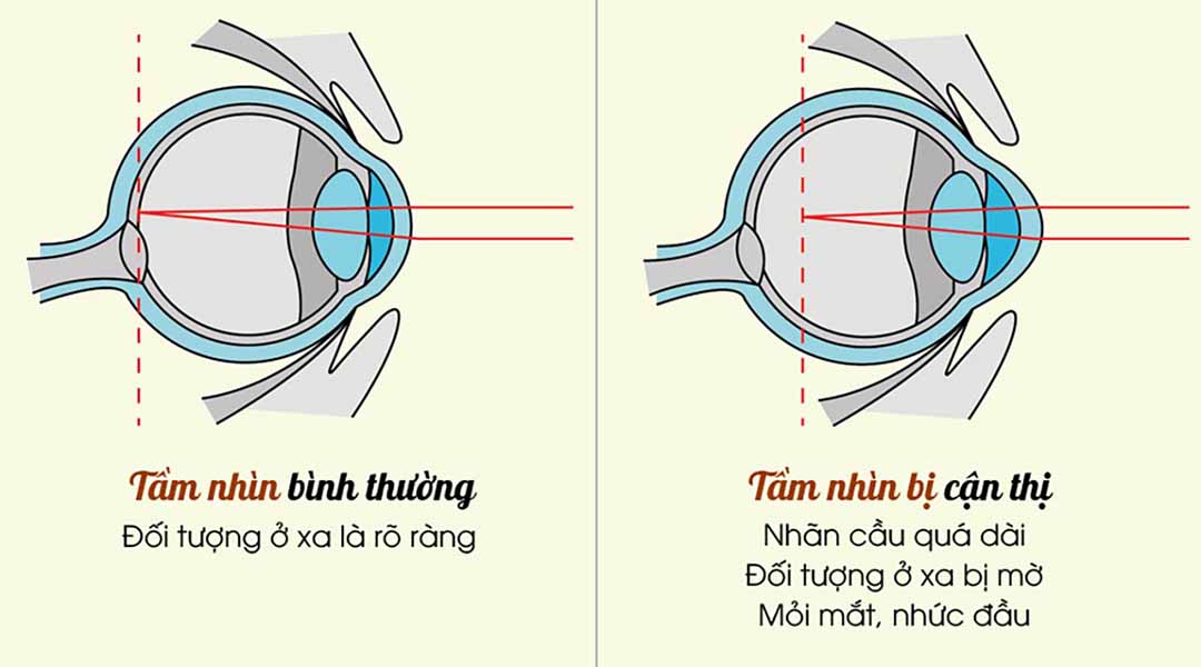 Cận thị và sức khỏe mắt ở trẻ em và người lớn