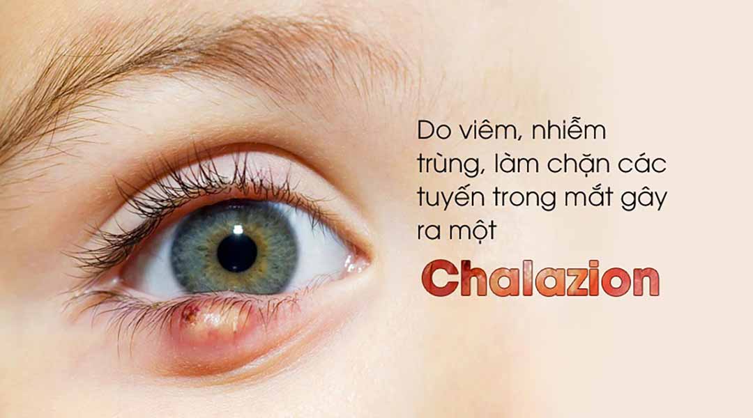 Chalazion (chắp) là gì?