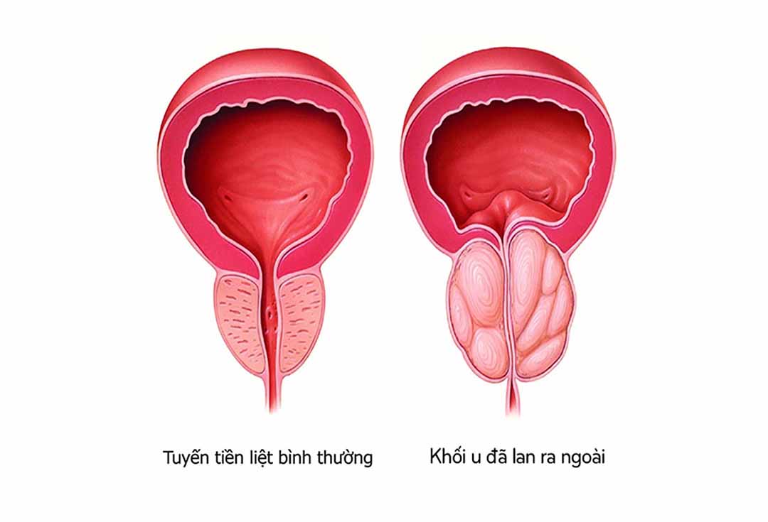 Liệu pháp hormon thường được sử dụng nếu khối u đã lan ra ngoài tuyến tiền liệt.