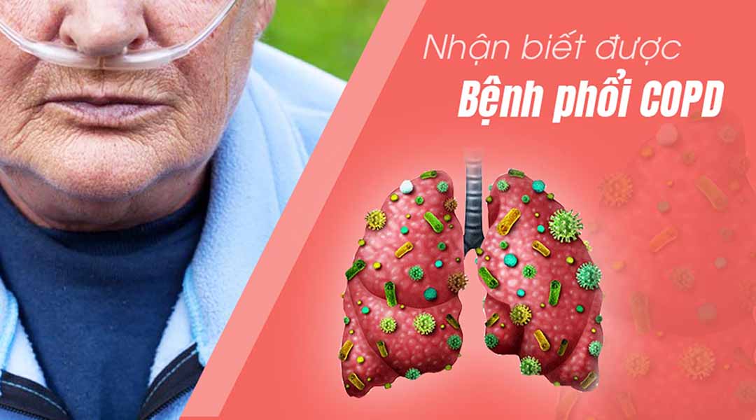 Làm thế nào nhận biết được bệnh phổi tắc nghẽn mạn tính (COPD - Chronic Obstructive Pulmonary Disease)?