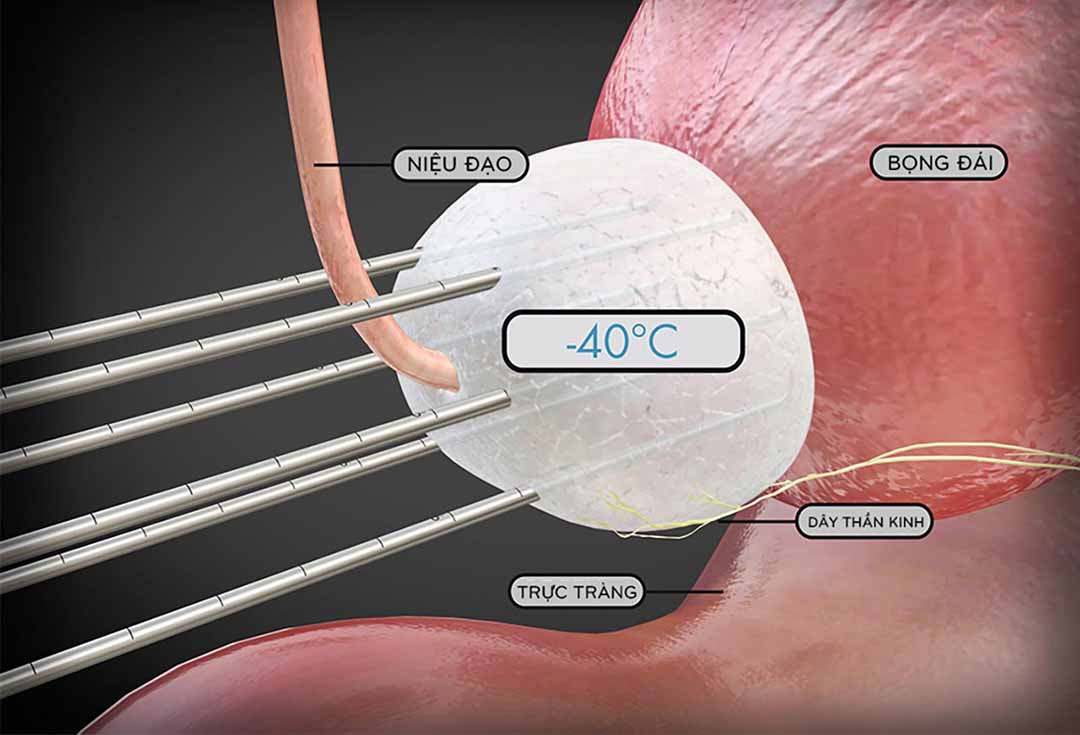 Liệu pháp áp lạnh trong điều trị ung thư tuyến tiền liệt