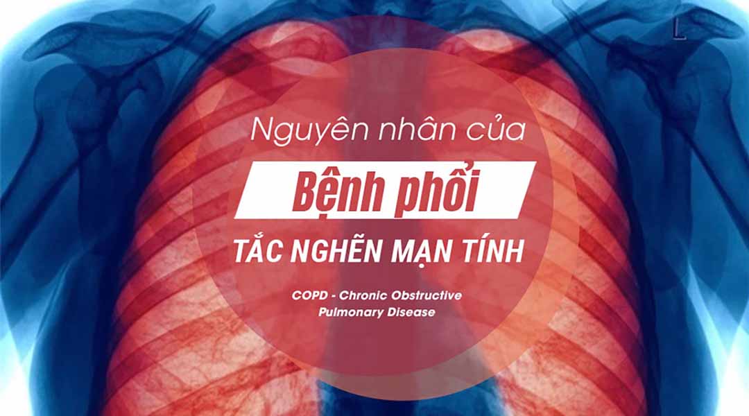 Nguyên nhân của bệnh phổi tắc nghẽn mạn tính (COPD - Chronic Obstructive Pulmonary Disease)