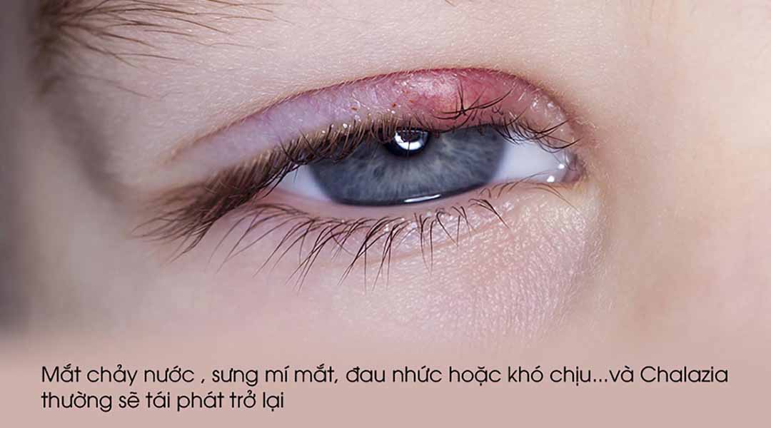 Các triệu chứng của Chalazion thường gây ra cảm giác khó chịu.