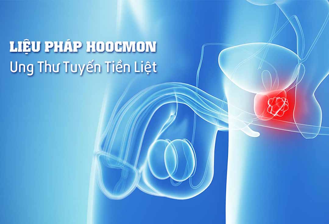 Ung thư tuyến tiền liệt: Liệu pháp hormon