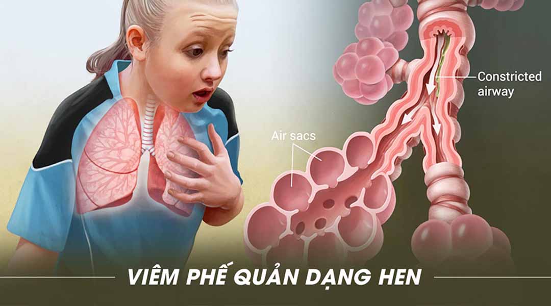 Viêm phế quản dạng hen