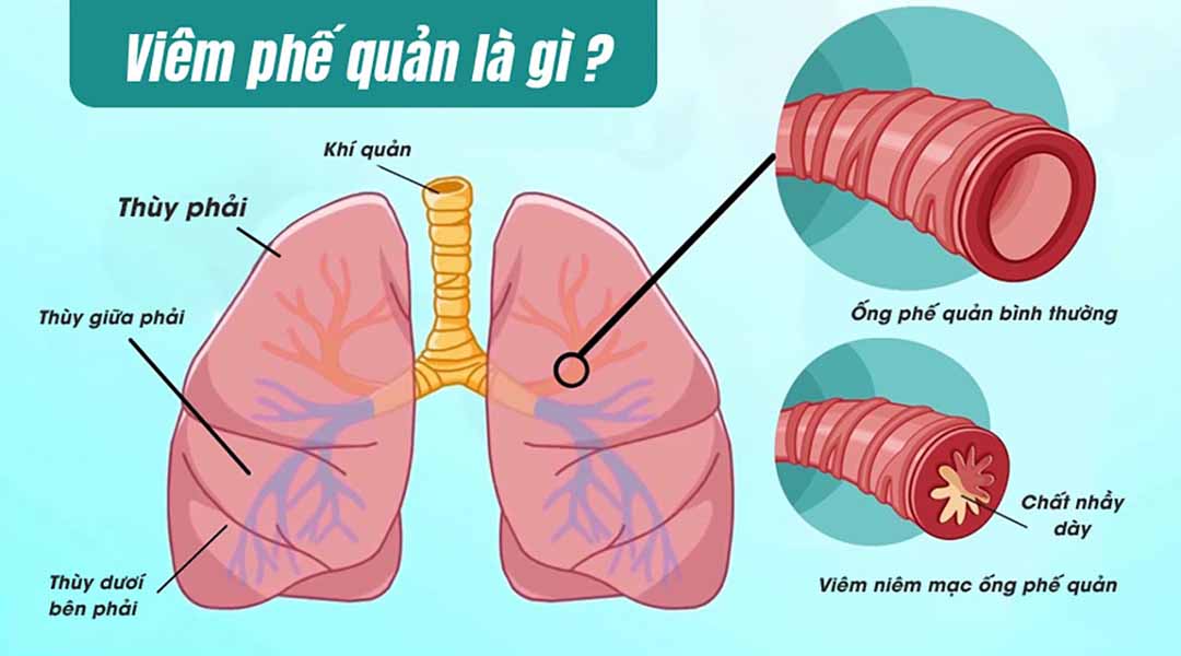 Viêm phế quản là gì?