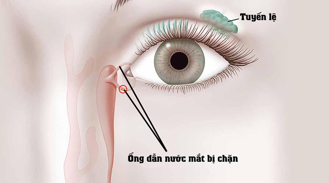 6 phương pháp điều trị cho một ống dẫn nước mắt bị chặn