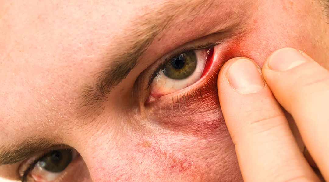 Bệnh hồng ban mắt là gì?