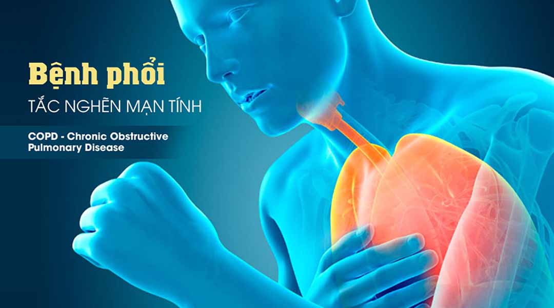 Bệnh phổi tắc nghẽn mạn tính (COPD - Chronic Obstructive Pulmonary Disease) bùng phát là gì?