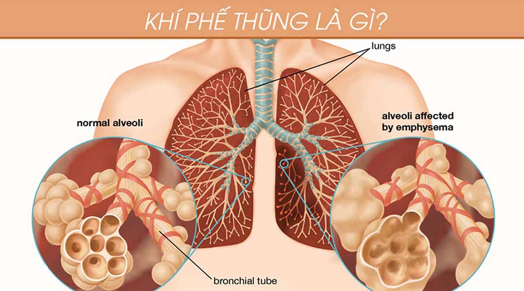 Khí phế thũng là gì?