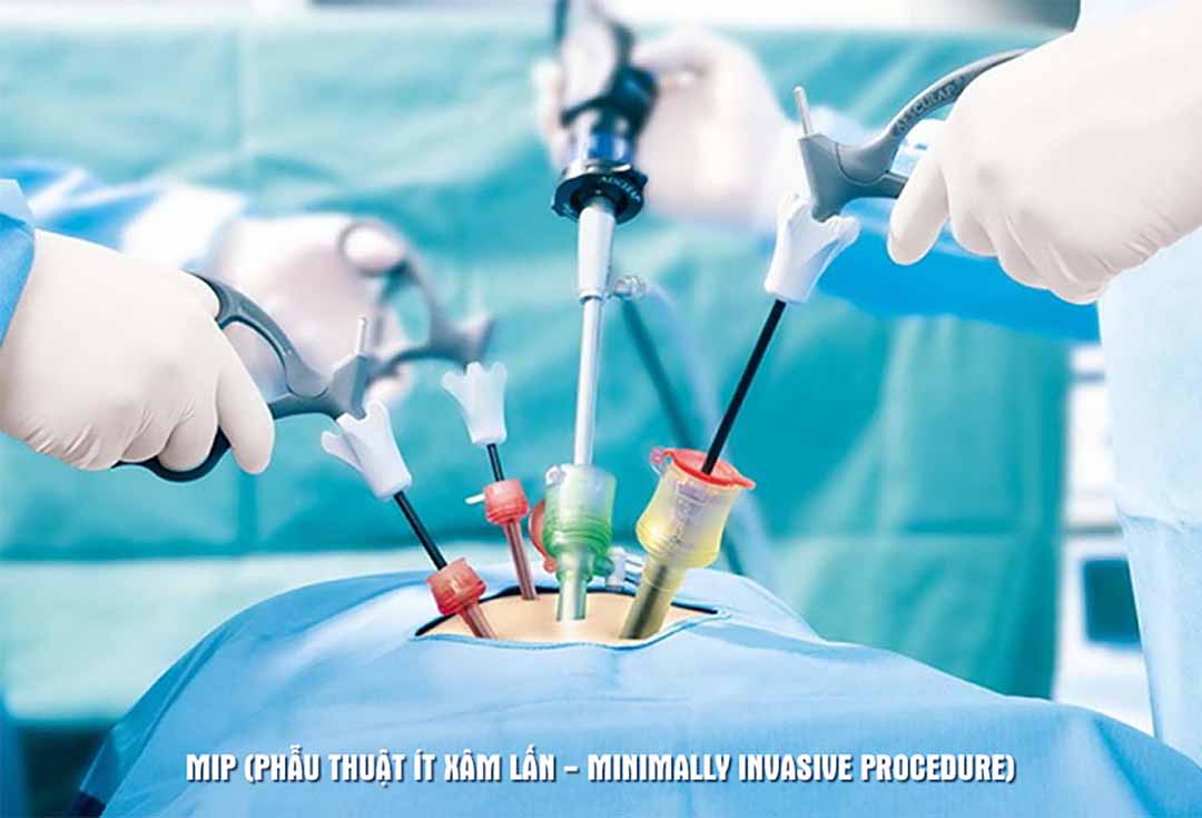 Hiện nay có hai cách tiếp cận với phẫu thuật này, đó là phẫu thuật truyền thống hoặc phẫu thuật mở và phẫu thuật bằng phương pháp xâm lấn tối thiểu hoặc MIP.