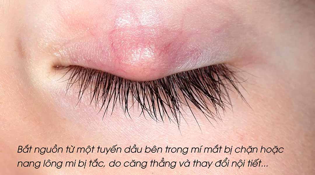 Các nguyên nhân phổ biến của triệu chứng sưng ở mí mắt.