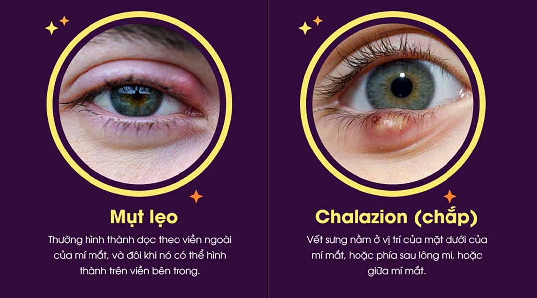 Phân biệt một mụt lẹo hay Chalazion (chắp) ở mí mắt?