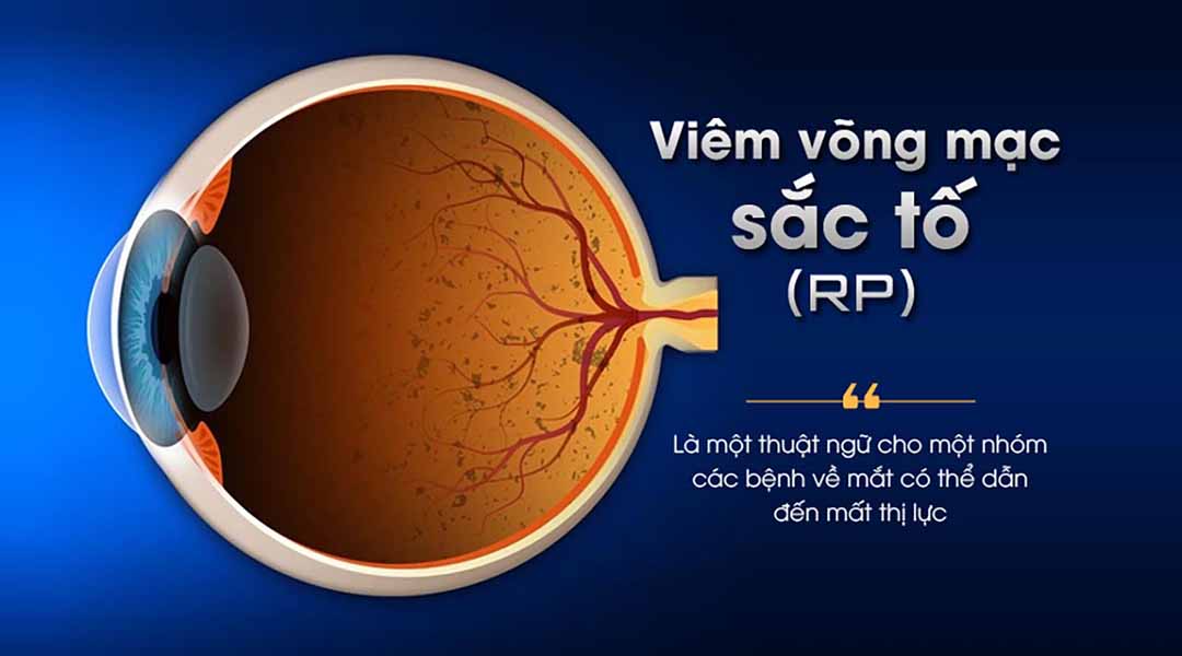 Viêm võng mạc sắc tố (RP) là gì?