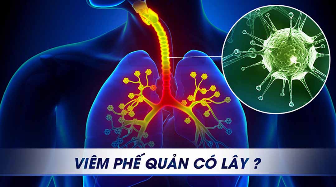 Viêm phế quản có lây hay không?