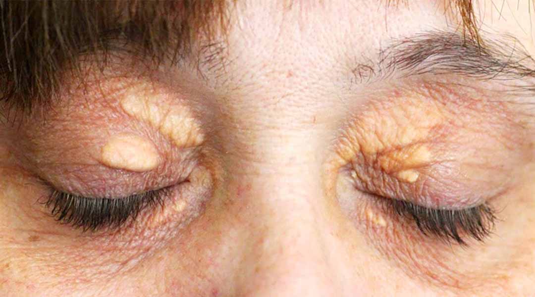 Ban vàng quanh mắt (Xanthelasma) là gì?