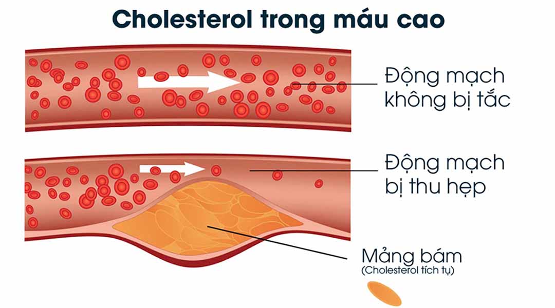 Cholesterol cao hình thành các mảng bám trong động mạch.