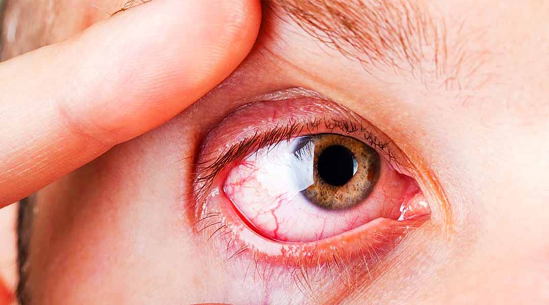Mắt bị kích thích và 6 nguyên nhân phổ biến