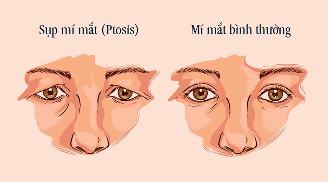 Sụp mí mắt (Ptosis)