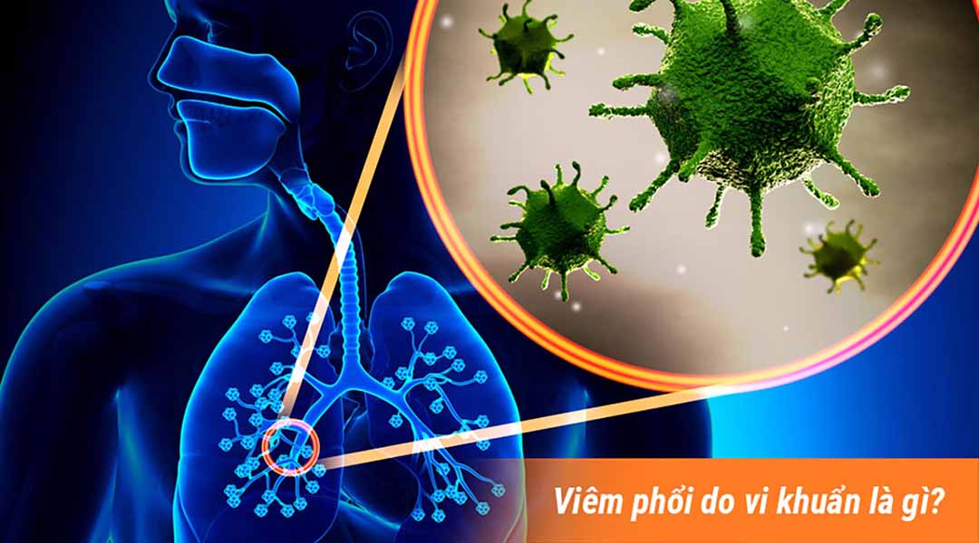 Viêm phổi do vi khuẩn là gì?