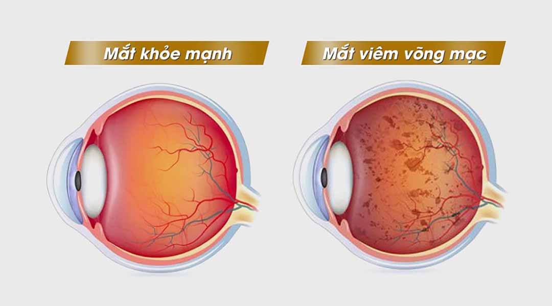 Viêm võng mạc