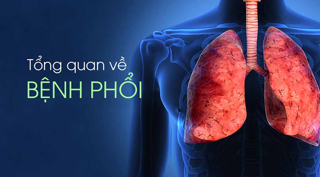 Tổng quan về bệnh phổi