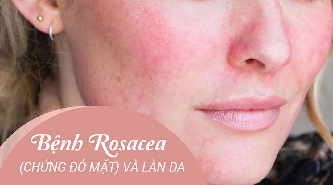 Bệnh Rosacea (chứng đỏ mặt) và làn da