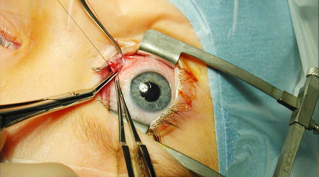 Mắt được phẩu thuật lấy ra khỏi hốc mắt để thay thế mắt giả.