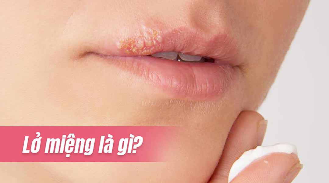 Lở miệng là gì?