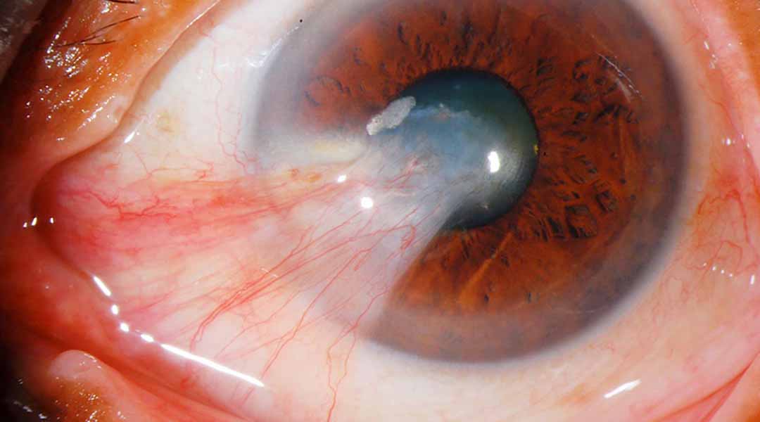 Mộng thịt mắt (Pterygium) là gì?