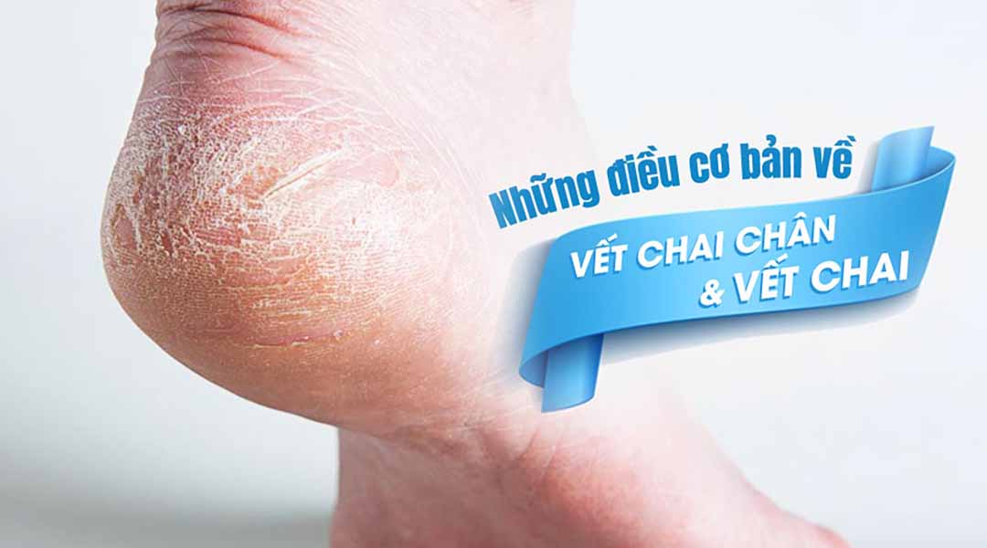 Tìm hiểu những điều cơ bản về vết chai chân và vết chai