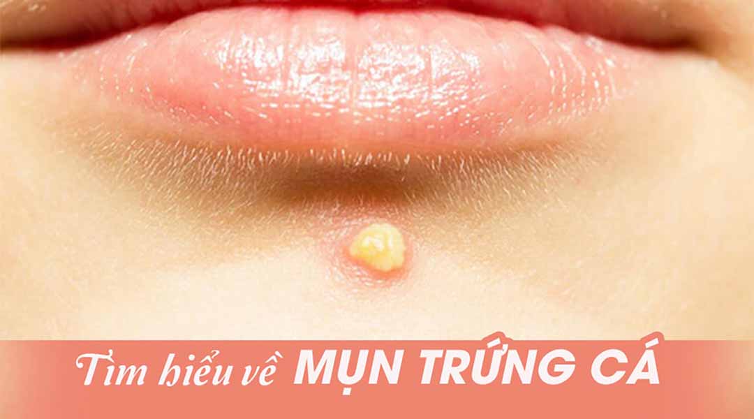 Tìm hiểu về mụn trứng cá