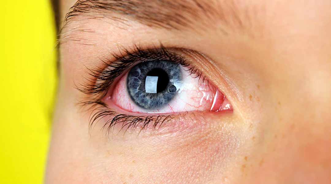 Khô mắt có thể xảy ra ở mọi lứa tuổi, nhưng phổ biến hơn ở những người trên 65 tuổi.