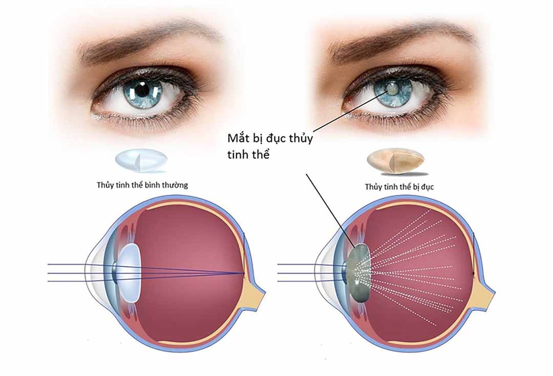 Triệu chứng đục thủy tinh thể