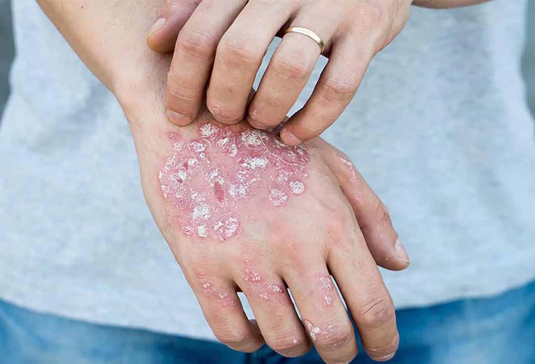 Bệnh chàm là một thuật ngữ chung mô tả một số tình trạng khác nhau trong đó da bị viêm, đỏ, bong vảy và ngứa.