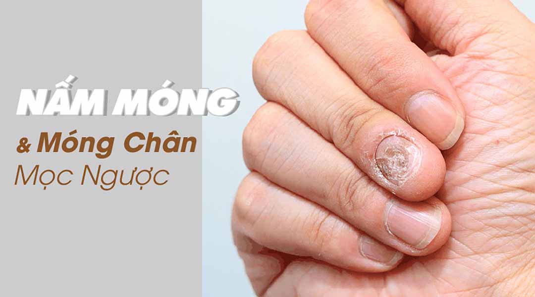 Nấm móng và móng chân mọc ngược