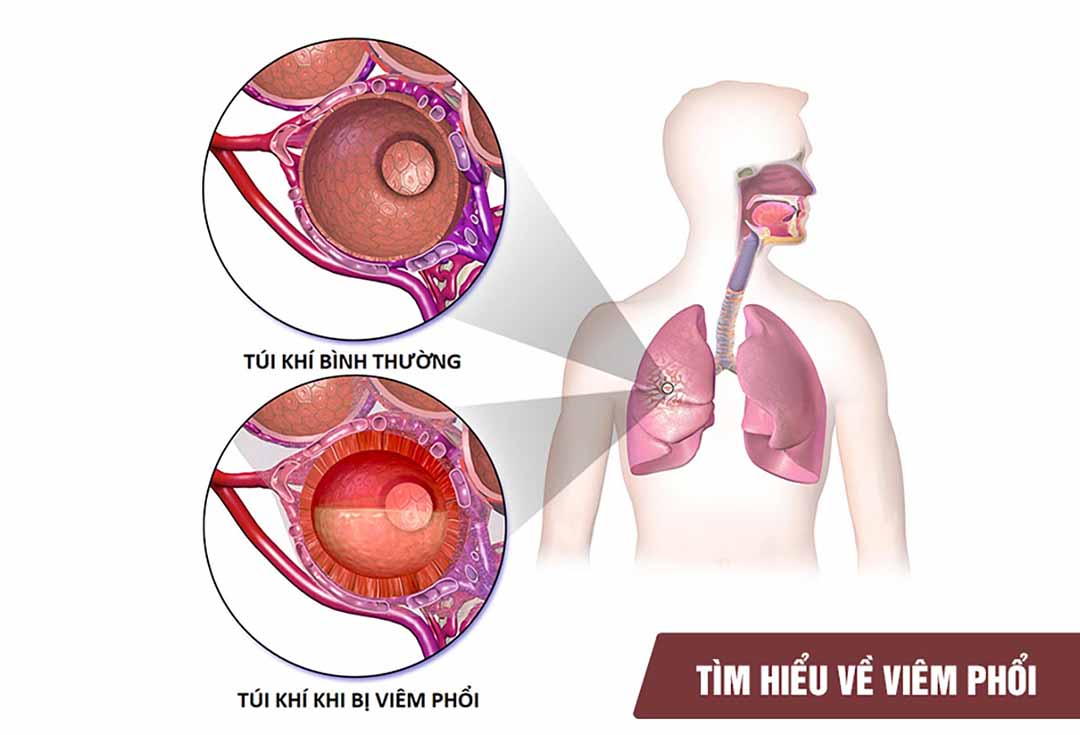 Tìm hiểu về viêm phổi là gì?