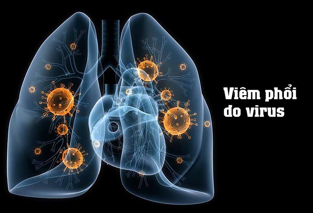 Viêm phổi do virus là gì?
