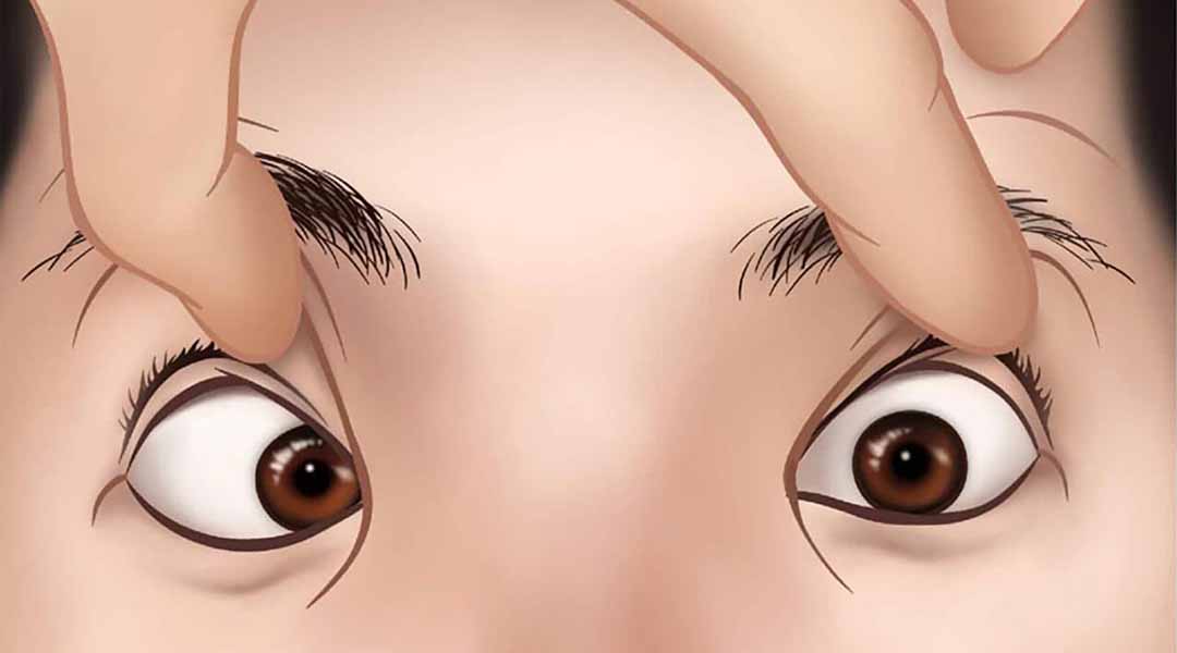 Triệu chứng phổ biến của song thị là có vẻ bề ngoài "mắt lác" (mắt lé).