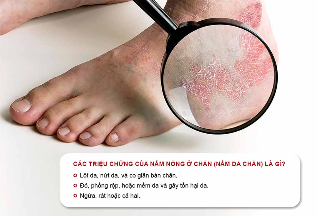 Lột da, nứt da, và co giãn bàn chân là một trong những triệu chứng phổ biến của nấm da chân.