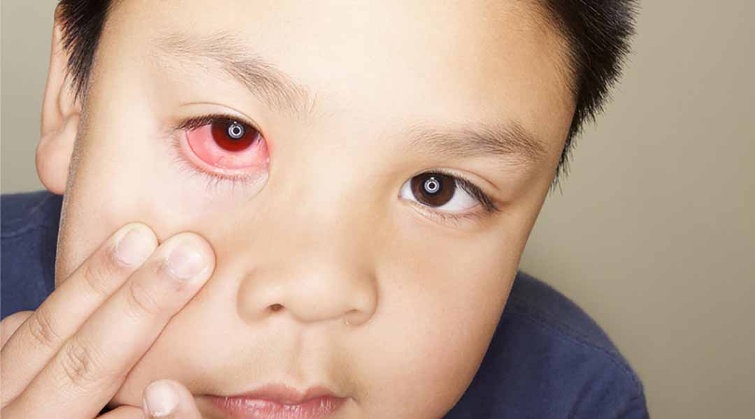 Hãy nhnah chóng đưa con bạn đến khám mắt cho bất cứ các vấn đề nào liên quan đến mắt trẻ.