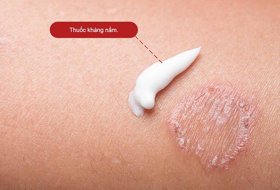 Sử dụng thuốc kháng nấm thoa trực tiếp lên da để điều trị nấm da chân trong hầu hết các trường hợp